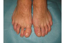 Psoriasis Arthritis psa_zehen_1.jpg